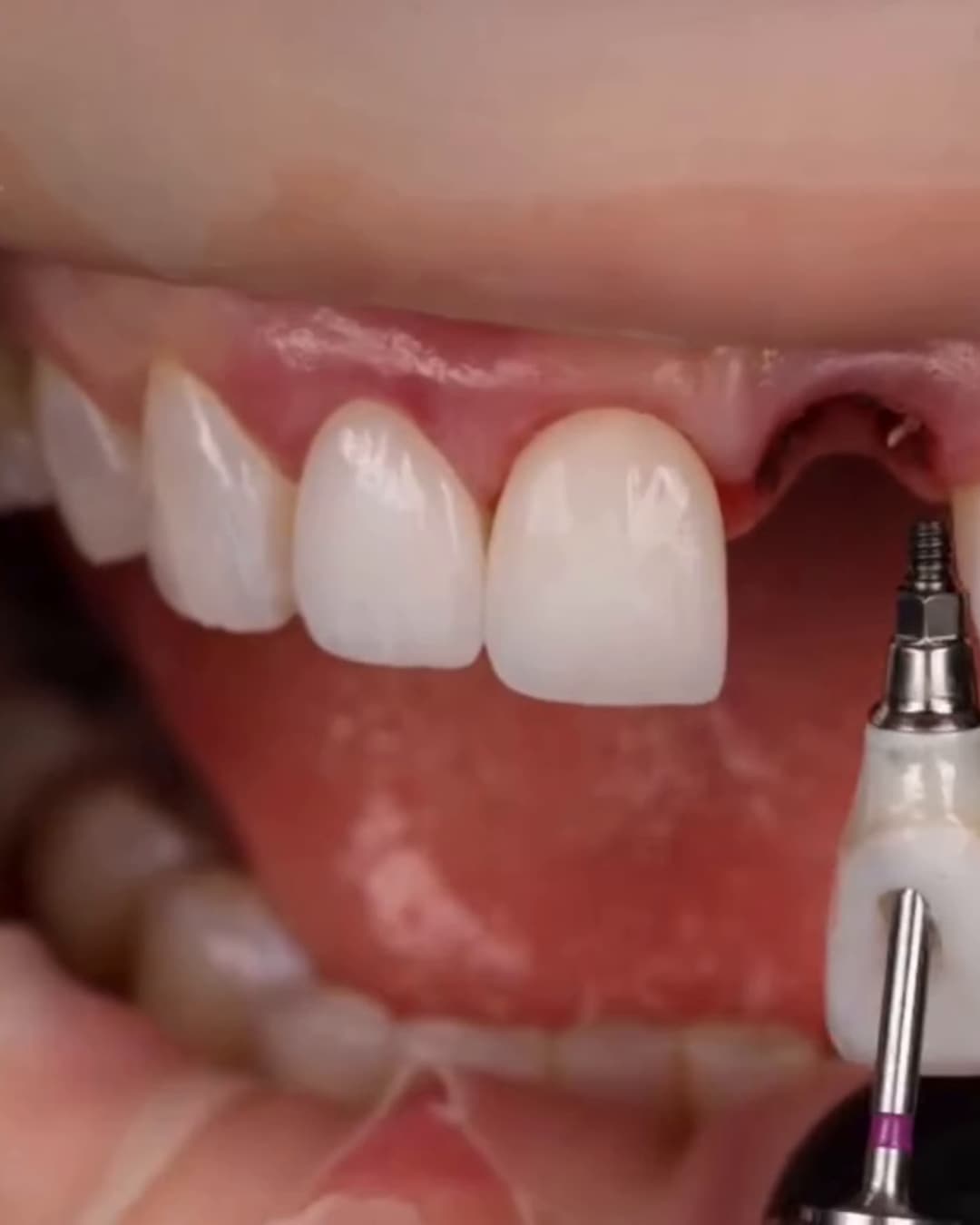 Render de implante dentário do Studio Orofacial
